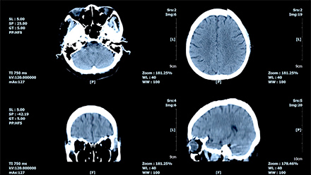 cures for Alzheimer's